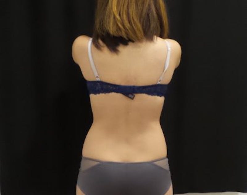 CoolSculpting Before & After Gallery - Patient 335435 - Image 3
