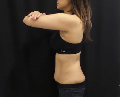 CoolSculpting Before & After Gallery - Patient 370127 - Image 1