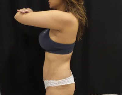 CoolSculpting Before & After Gallery - Patient 370127 - Image 2