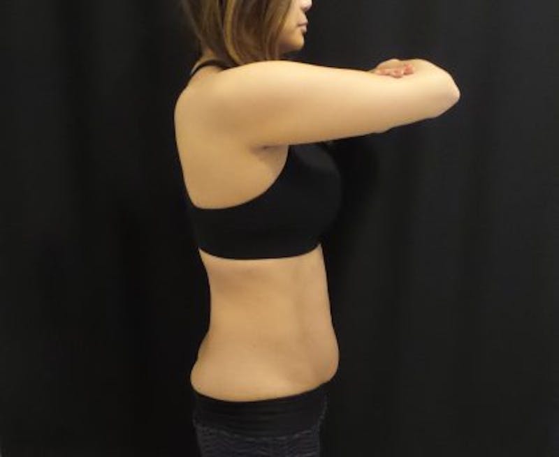 CoolSculpting Before & After Gallery - Patient 370127 - Image 3