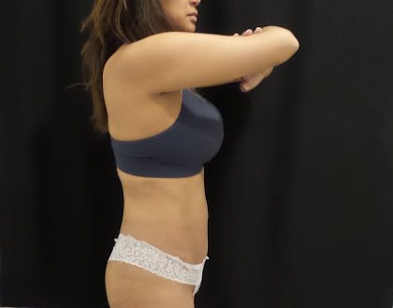 CoolSculpting Before & After Gallery - Patient 370127 - Image 4