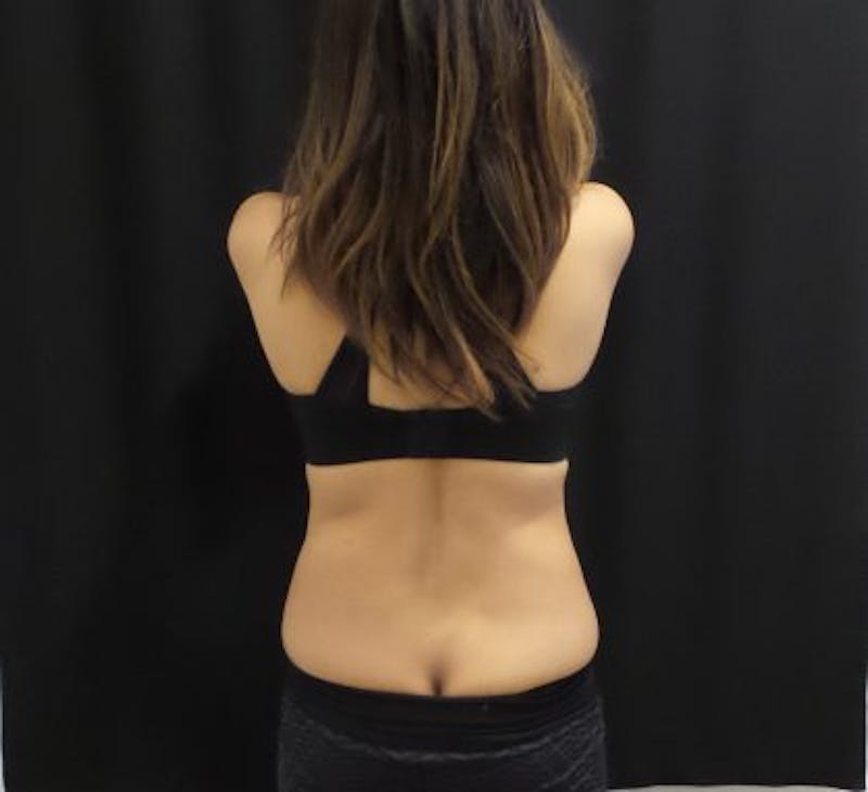 CoolSculpting Before & After Gallery - Patient 370127 - Image 5