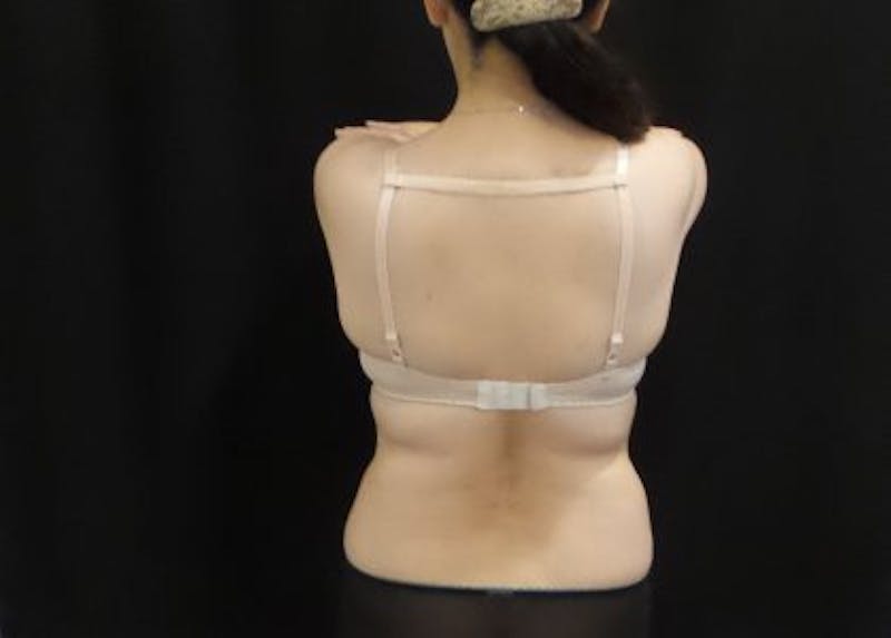 CoolSculpting Before & After Gallery - Patient 171984 - Image 3