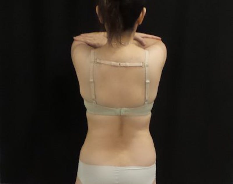 CoolSculpting Before & After Gallery - Patient 171984 - Image 4