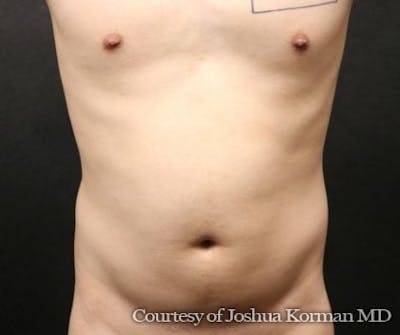 Ab Etching Before & After Gallery - Patient 416703 - Image 1