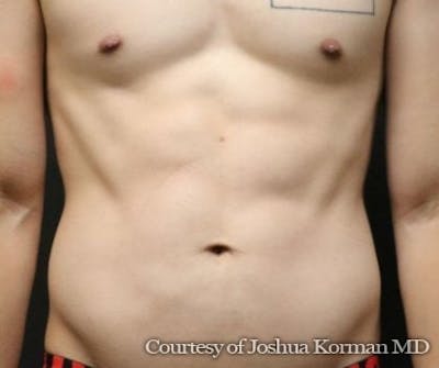Ab Etching Before & After Gallery - Patient 416703 - Image 2