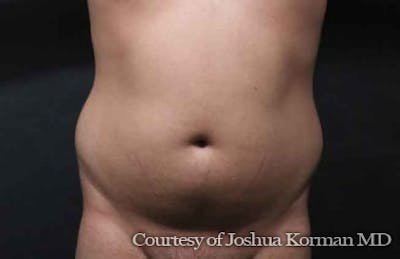 Liposuction Before & After Gallery - Patient 263837 - Image 1