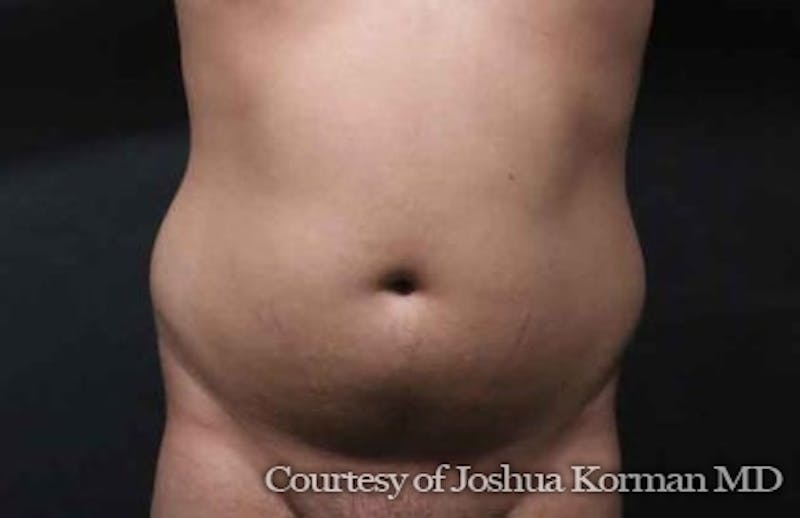 Liposuction Before & After Gallery - Patient 263837 - Image 1