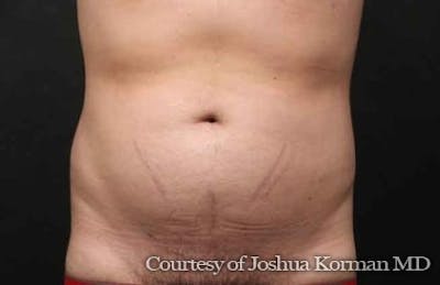 Liposuction Before & After Gallery - Patient 263837 - Image 2