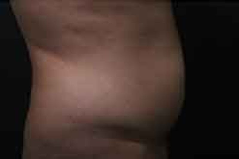 Liposuction Before & After Gallery - Patient 263837 - Image 3