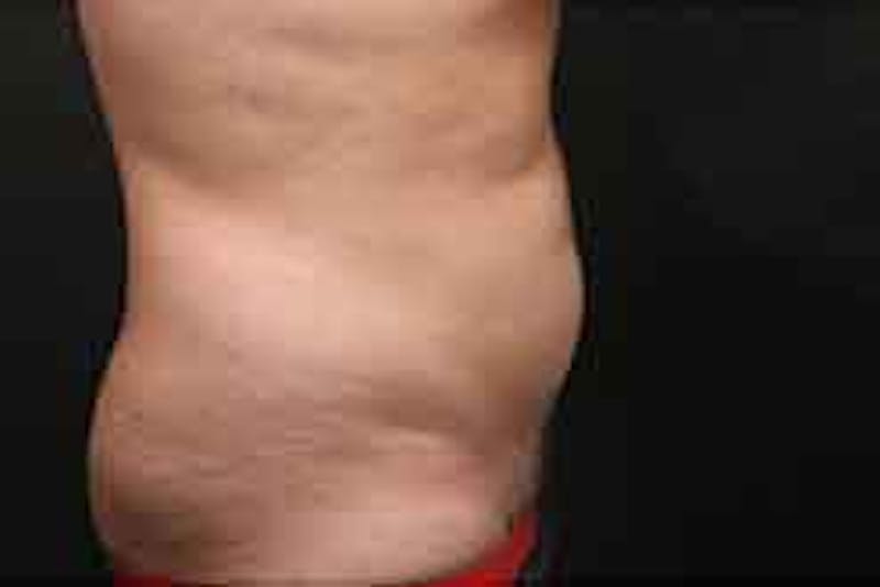 Liposuction Before & After Gallery - Patient 263837 - Image 4