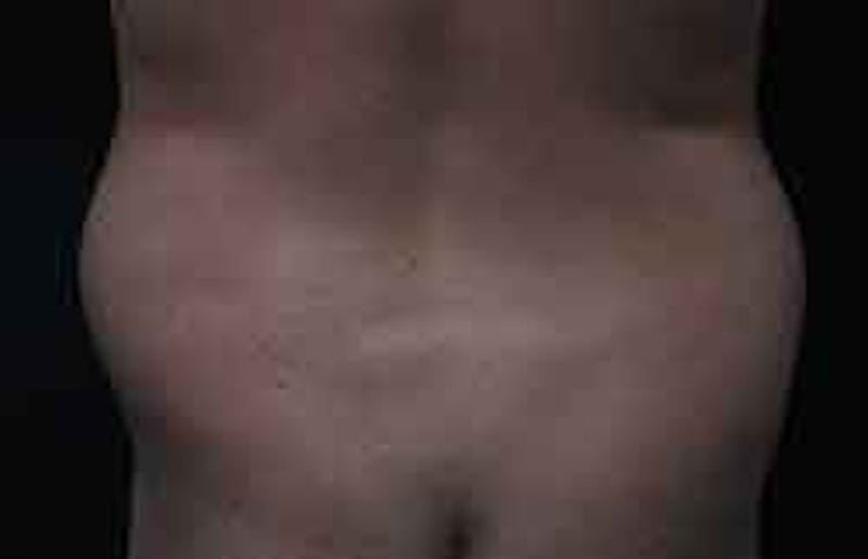 Liposuction Before & After Gallery - Patient 263837 - Image 5