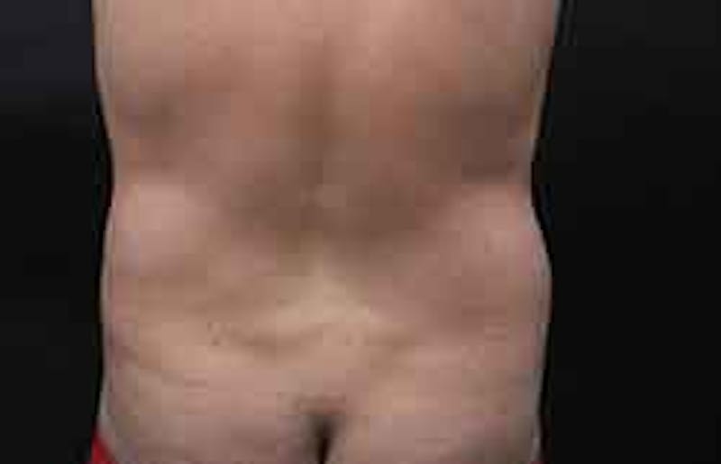 Liposuction Before & After Gallery - Patient 263837 - Image 6