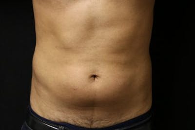 Liposuction Before & After Gallery - Patient 143808 - Image 1
