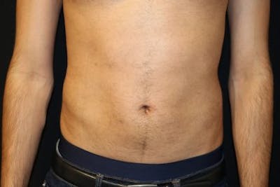 Liposuction Before & After Gallery - Patient 143808 - Image 2