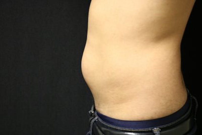 Liposuction Before & After Gallery - Patient 143808 - Image 3