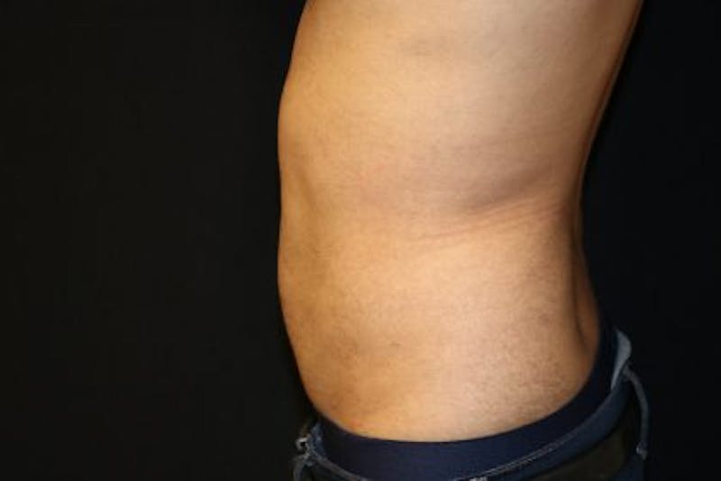 Liposuction Before & After Gallery - Patient 143808 - Image 4