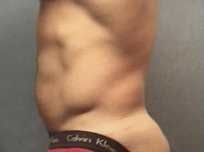 Liposuction Before & After Gallery - Patient 702523 - Image 2