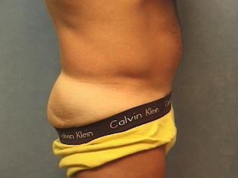 Liposuction Before & After Gallery - Patient 702523 - Image 3