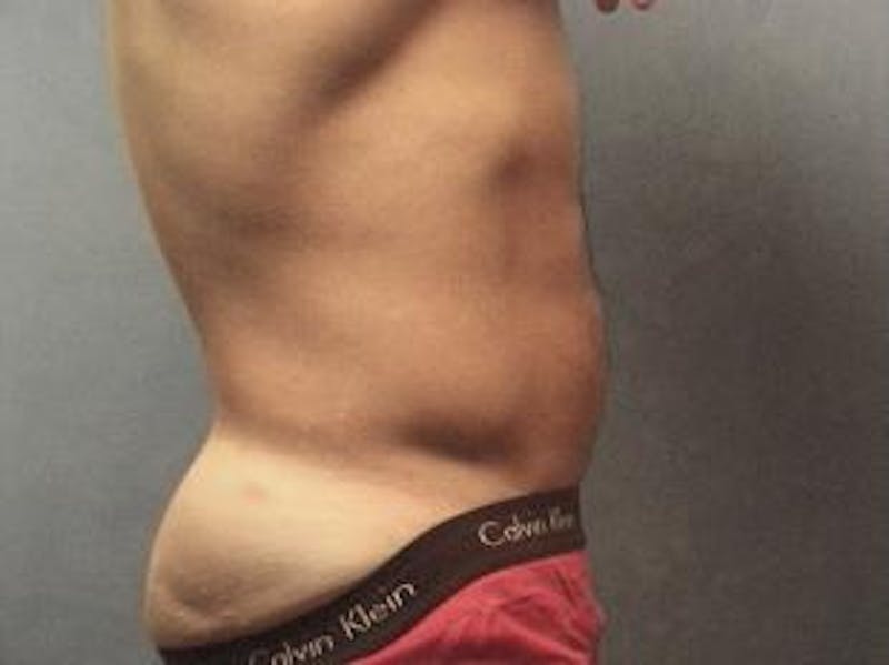 Liposuction Before & After Gallery - Patient 702523 - Image 4