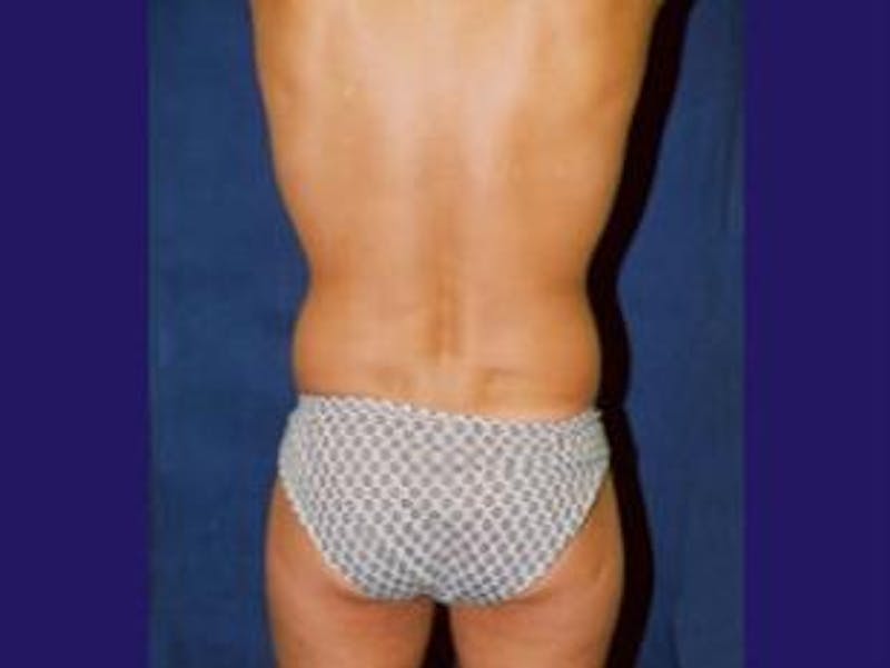 Liposuction Before & After Gallery - Patient 189734 - Image 1