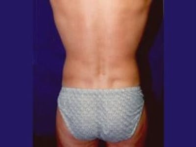 Liposuction Before & After Gallery - Patient 189734 - Image 2
