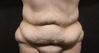 Tummy Tuck Before & After Gallery - Patient 794729 - Image 1