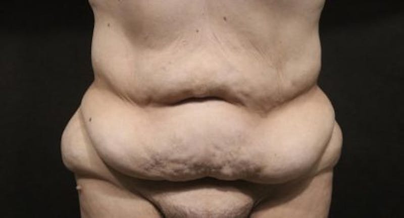 Tummy Tuck Before & After Gallery - Patient 794729 - Image 1