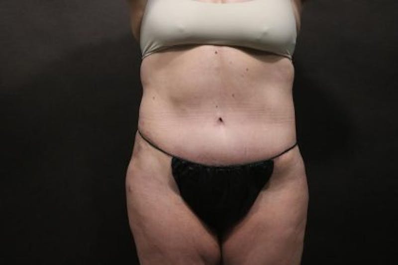 Tummy Tuck Before & After Gallery - Patient 794729 - Image 2