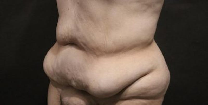 Tummy Tuck Before & After Gallery - Patient 794729 - Image 3