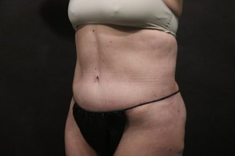Tummy Tuck Before & After Gallery - Patient 794729 - Image 4