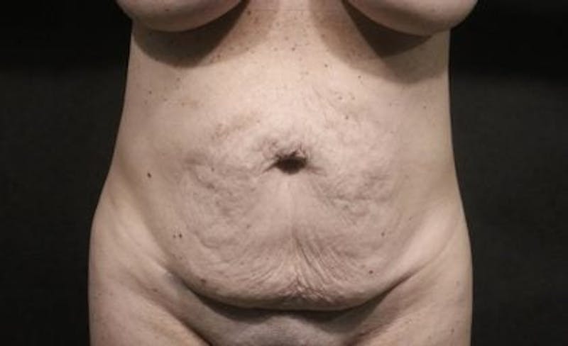 Tummy Tuck Before & After Gallery - Patient 395884 - Image 1