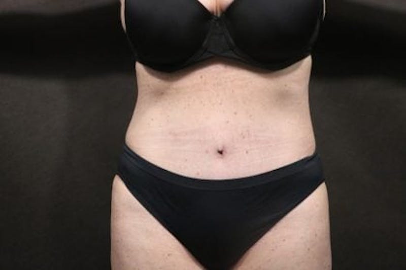 Tummy Tuck Before & After Gallery - Patient 395884 - Image 2