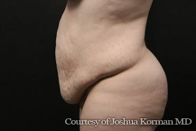 Tummy Tuck Before & After Gallery - Patient 752614 - Image 1