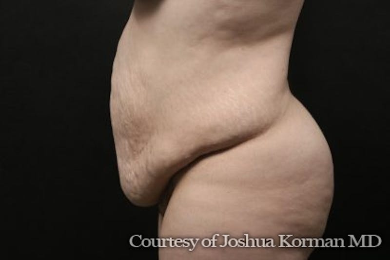 Tummy Tuck Before & After Gallery - Patient 752614 - Image 1