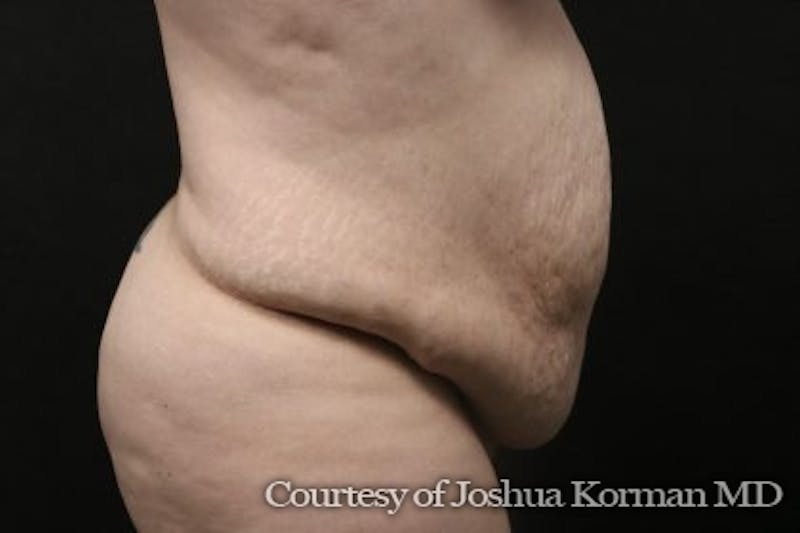 Tummy Tuck Before & After Gallery - Patient 752614 - Image 3