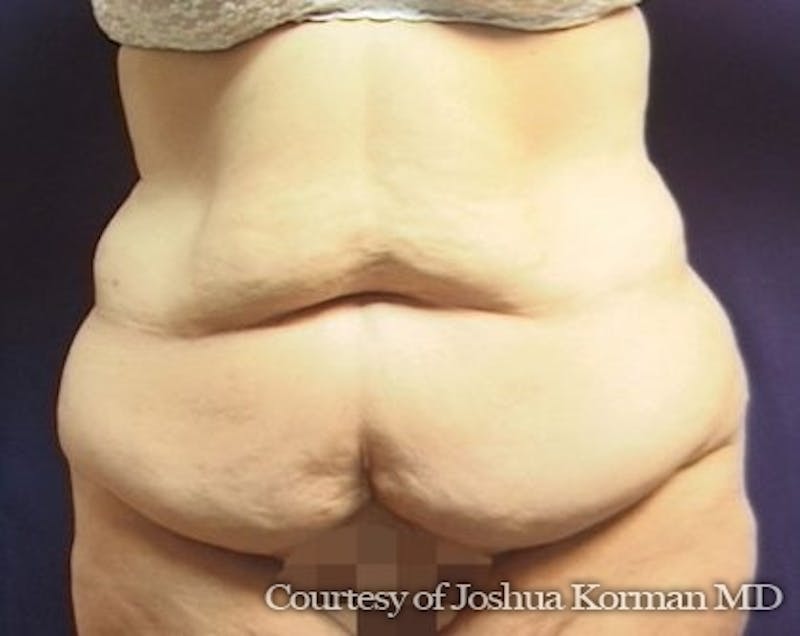 Tummy Tuck Before & After Gallery - Patient 299175 - Image 1