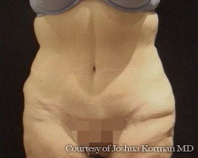 Tummy Tuck Before & After Gallery - Patient 299175 - Image 2