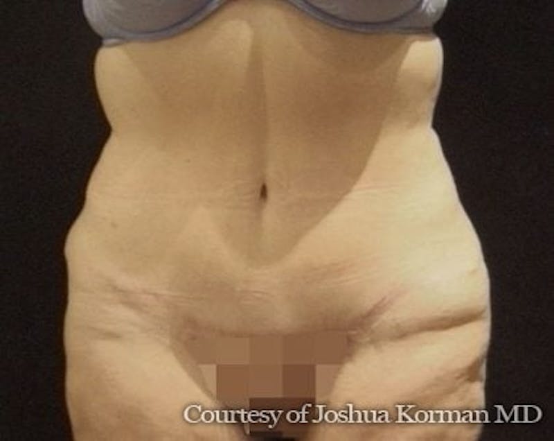 Tummy Tuck Before & After Gallery - Patient 299175 - Image 2