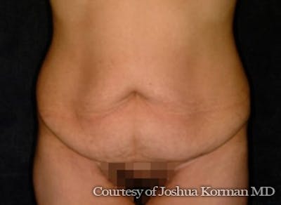 Tummy Tuck Before & After Gallery - Patient 212606 - Image 1