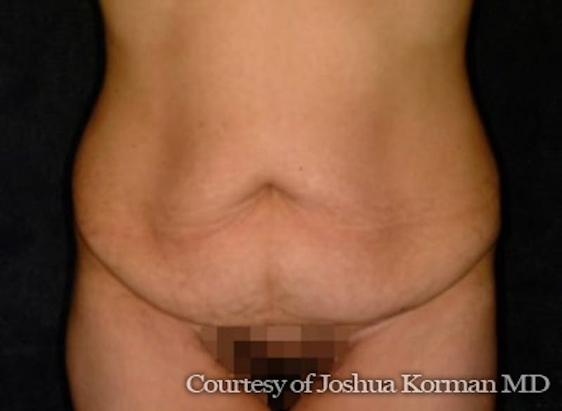 Tummy Tuck Before & After Gallery - Patient 212606 - Image 1