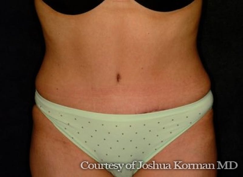 Tummy Tuck Before & After Gallery - Patient 212606 - Image 2