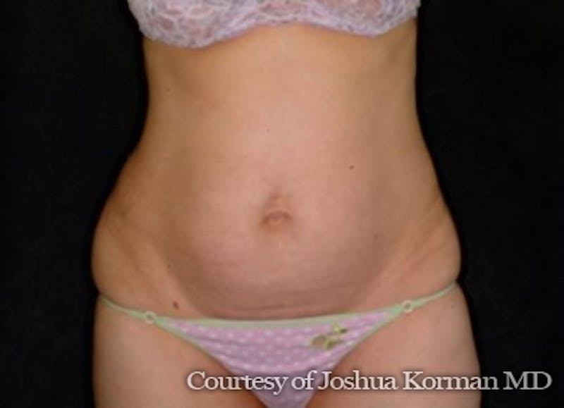 Tummy Tuck Before & After Gallery - Patient 370237 - Image 1