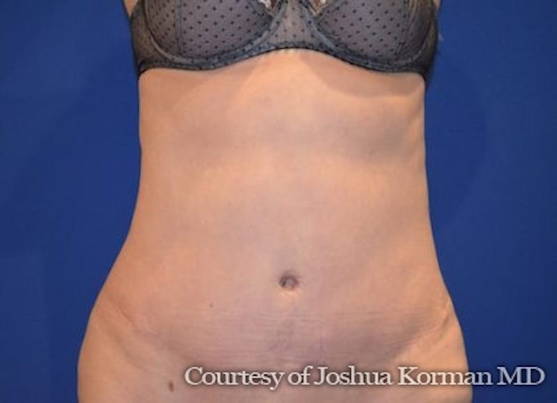 Tummy Tuck Before & After Gallery - Patient 370237 - Image 2