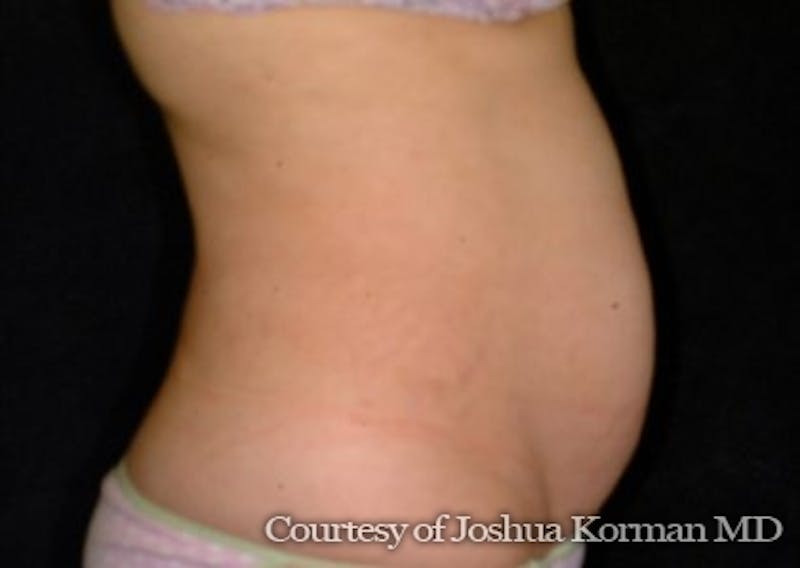 Tummy Tuck Before & After Gallery - Patient 370237 - Image 3