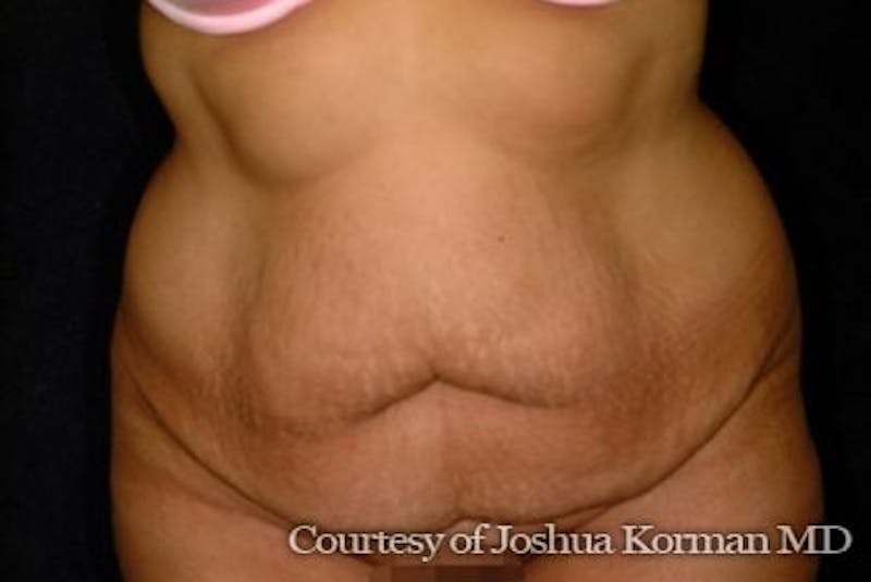Tummy Tuck Before & After Gallery - Patient 701751 - Image 1