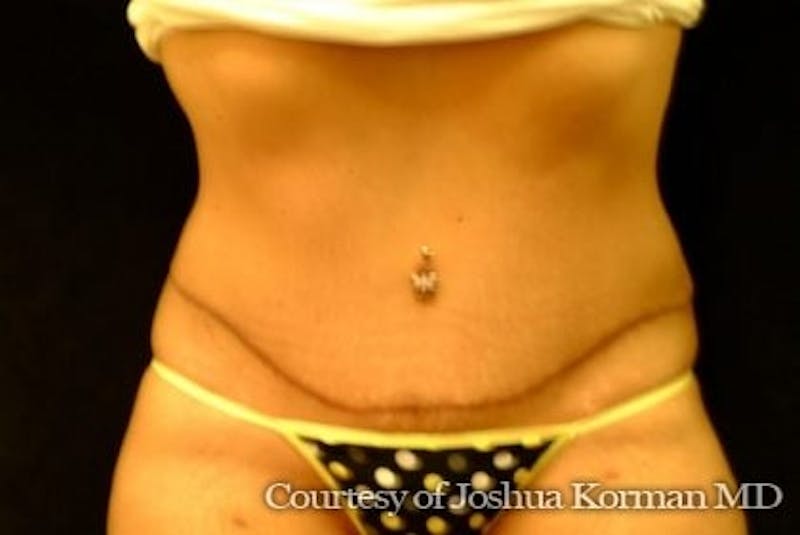 Tummy Tuck Before & After Gallery - Patient 701751 - Image 2