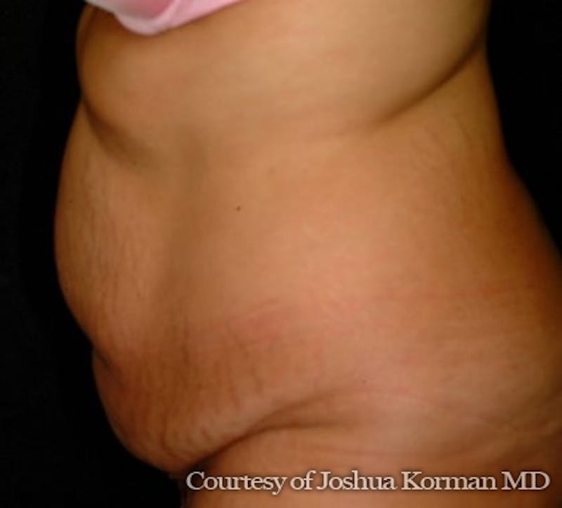 Tummy Tuck Before & After Gallery - Patient 701751 - Image 3