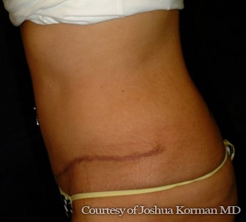 Tummy Tuck Before & After Gallery - Patient 701751 - Image 4
