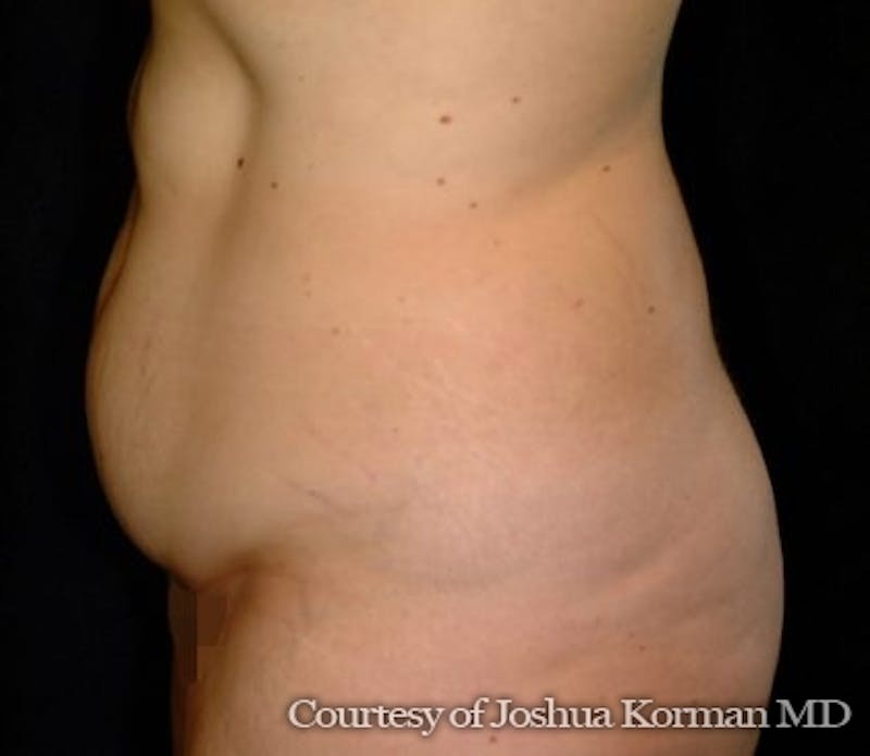 Tummy Tuck Before & After Gallery - Patient 161409 - Image 1
